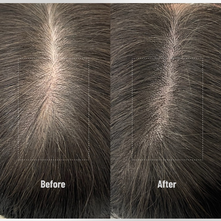 女性SMP BEFORE & AFTER