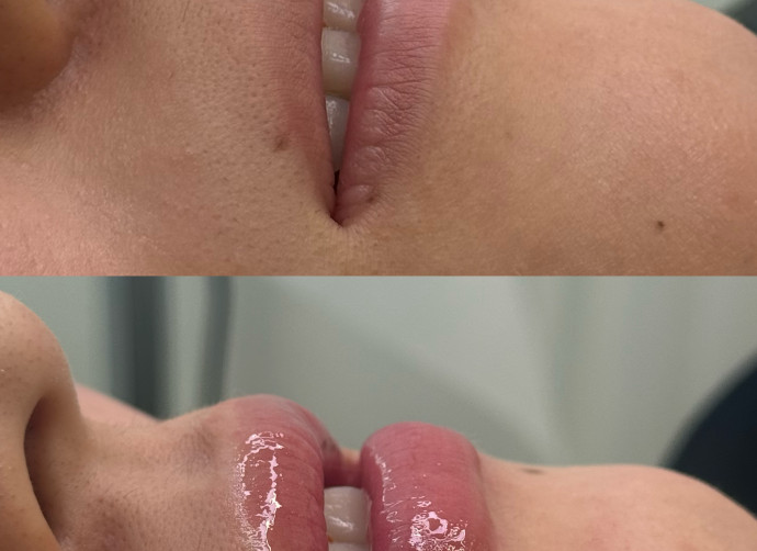メンズリップ BEFORE & AFTER